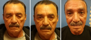 Ptosis-Blepharoplasty