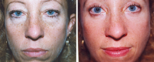 Invisible Blepharoplasty | Dr. Lisa Bunin