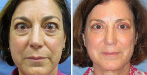Allentown, PA | Eyelid Surgery