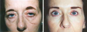 Blepharoplasty | Allentown, PA