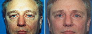 Allentown, PA | Eyelid Surgery
