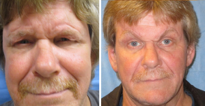 Allentown, PA | Blepharoplasty