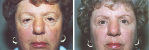 Dr. Lisa Bunin | Blepharoplasty