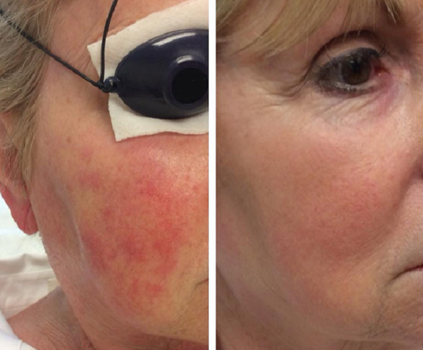 Ipl Light Treatment Before And After Photos Lisa Bunin Md 