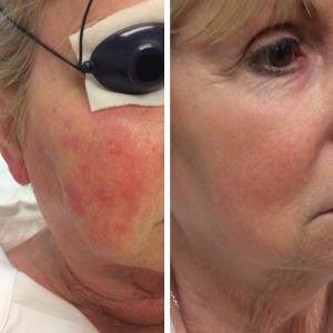 Allentown, PA | IPL Treatment