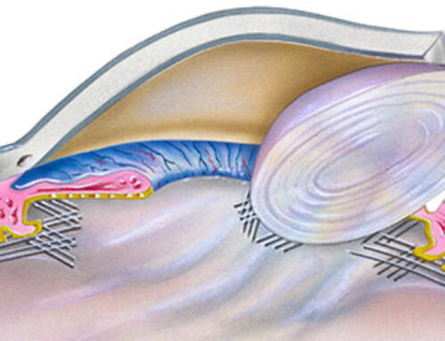 Cataract Lens Replacement Surgery