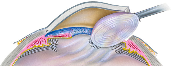 cataract lens replacement