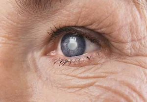 Cataract Surgery Patient Testimonials