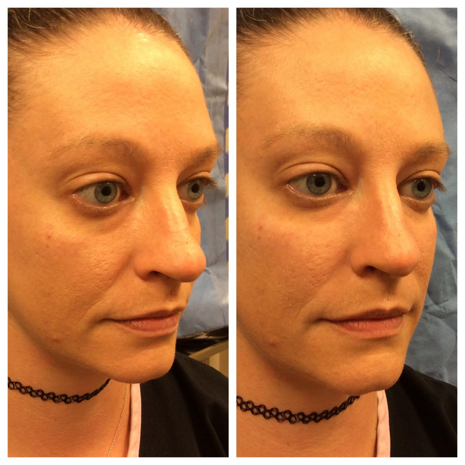 RHA Facial Fillers Before and Afters | Lisa Bunin MD