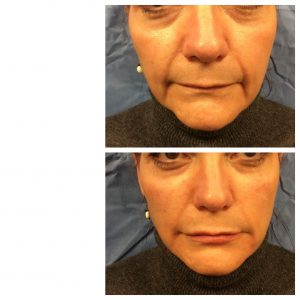 RHA Facial Fillers Before & After