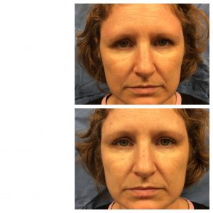 RHA Facial Fillers before and after