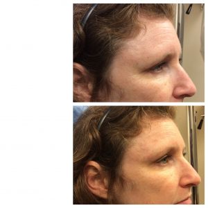 RHA Facial Fillers Before and After