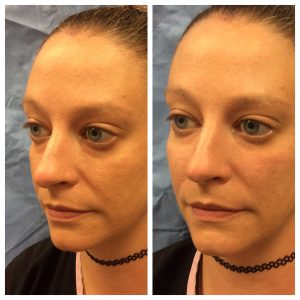 RHA Facial Fillers before and after