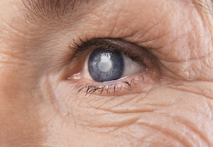 Custom cataract surgery