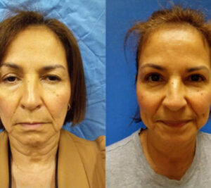 Blepharoplasty