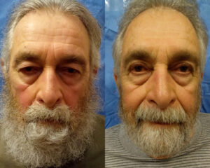 Ptosis Droopy Eyelid