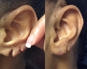 earlobe repair