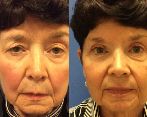 https://lisasbuninmd.com/before-afters/eyelift-blepharoplasty-before-and-after-photos/