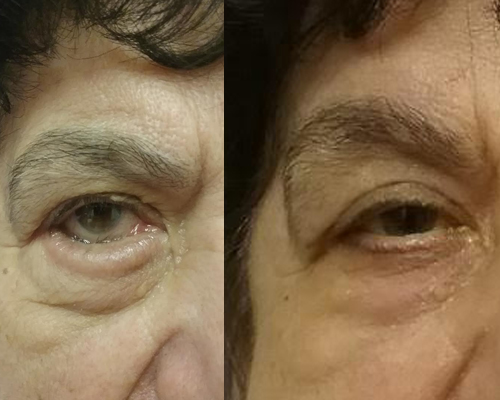 https://lisasbuninmd.com/eyelid-surgery-and-festoons-before-after-photos/