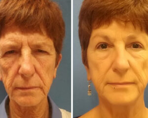 blepharoplasty