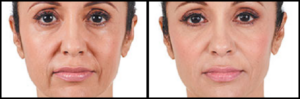 Juvederm® Ultra Plus XC Facial Filler