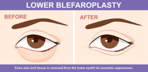 Oculoplasty_Blepharolasty